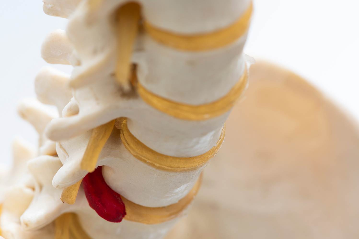 Close-up,View,Of,Artificial,Human,Herniated,Lumbar,Intervertebral,Disc,Model Close-up view of artificial human herniated lumbar intervertebral disc model